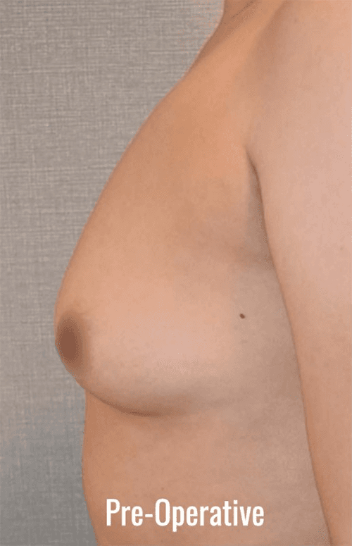 Pre-Operative breast augmentation