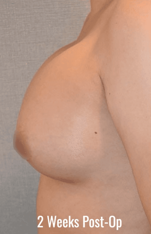 2 Weeks Post-Op breast augmentation