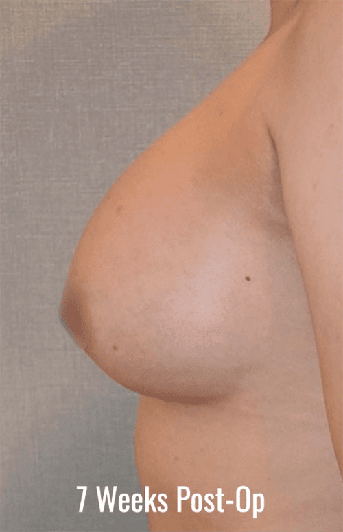 7 Weeks Post-Op breast augmentation