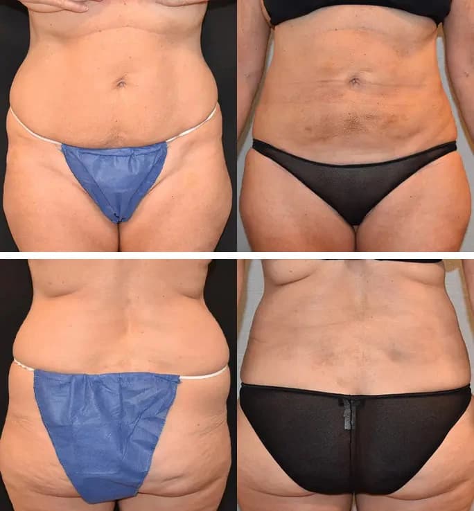 Patient 5 (BodyTite Before and After Photos)