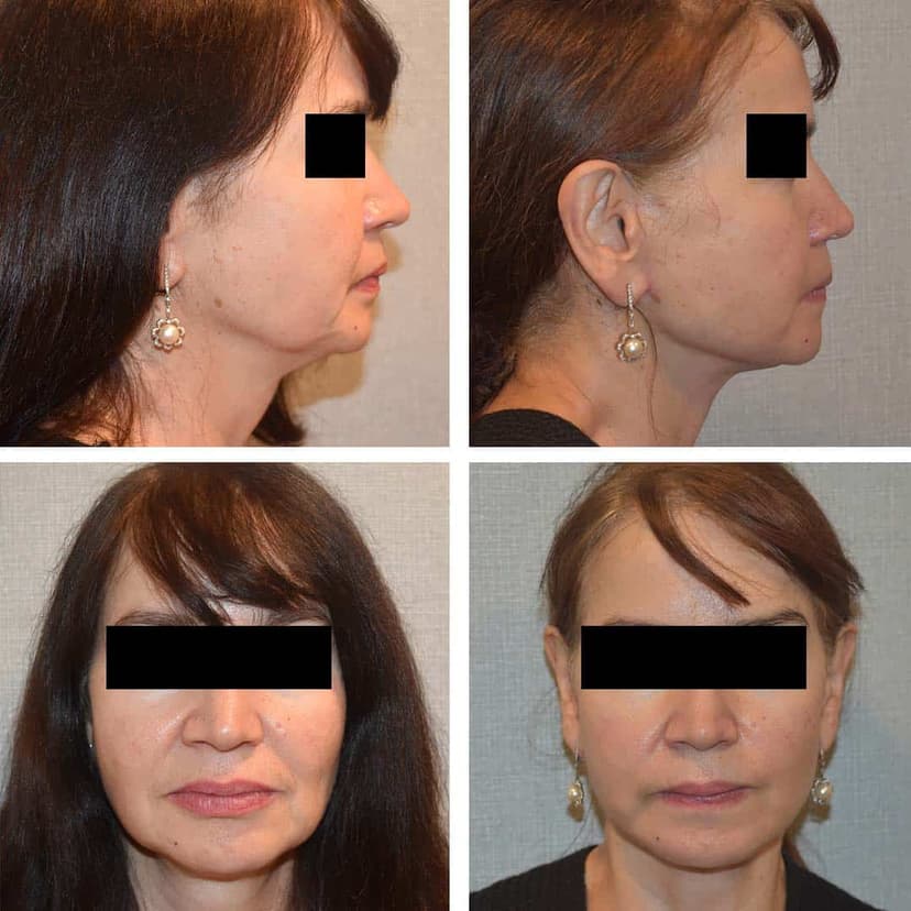 Patient 6 (Facelift Before and After 40 Years Old)