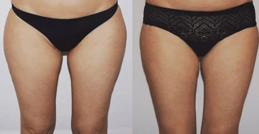 Patient 11 (Liposuction Before and After Photos of Outer Thighs)
