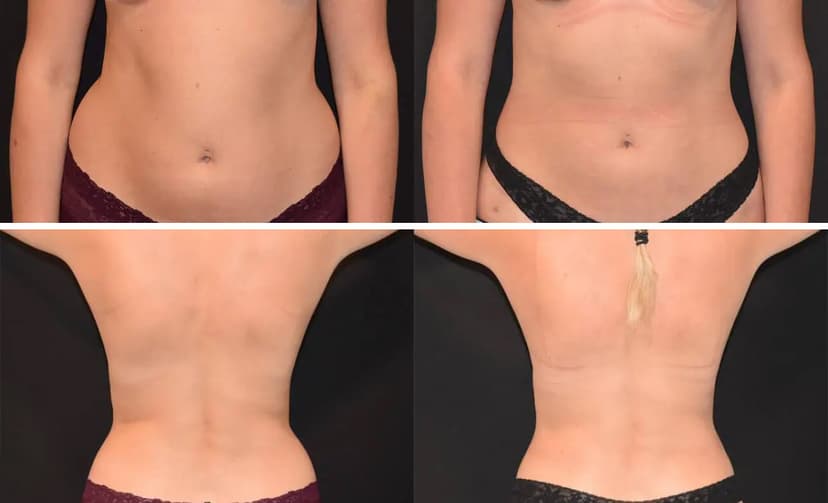 Patient 2 (Liposuction Abdomen & Waist Before & After Photo)