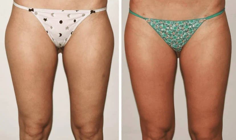 Patient 8 (Liposuction Before and After Photos of Outer Thighs)
