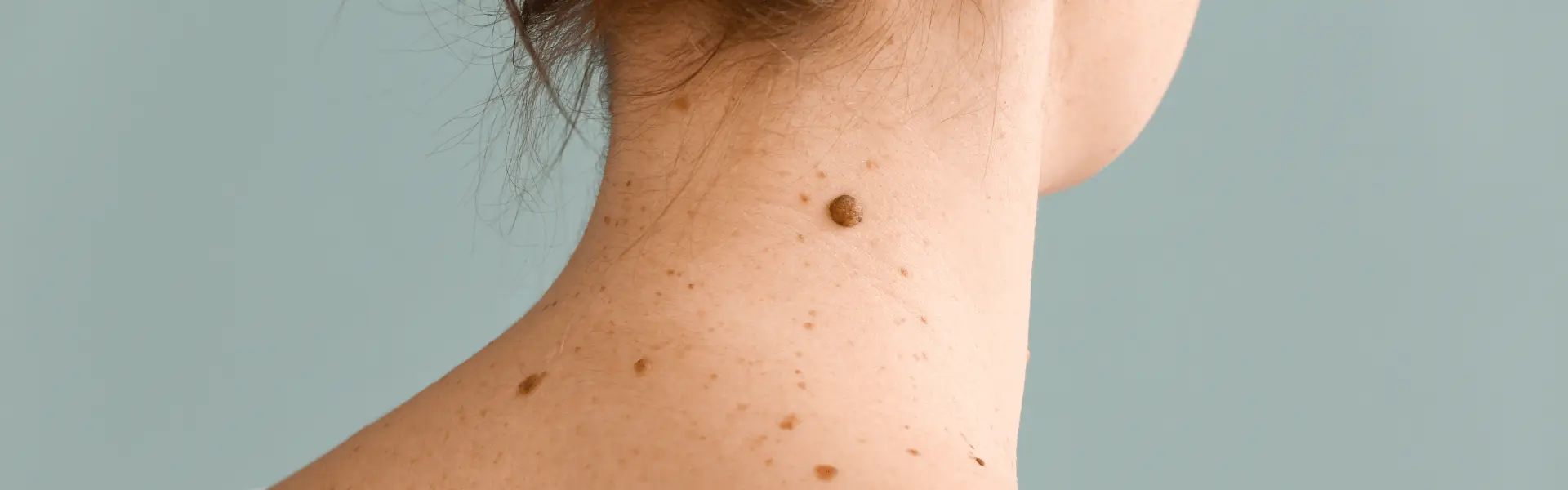 A woman with spots on her neck.