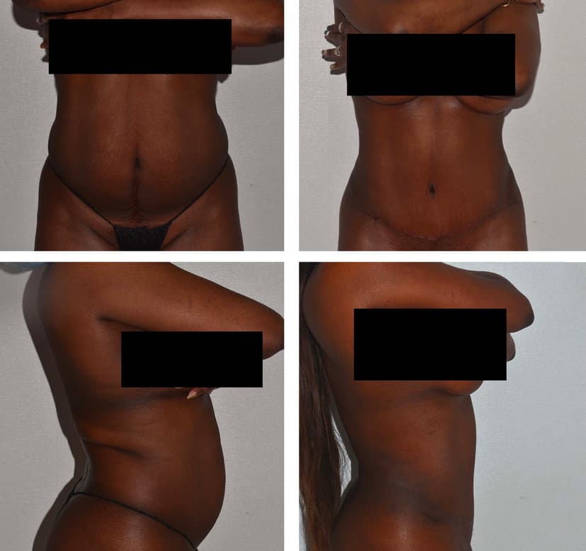Before and after