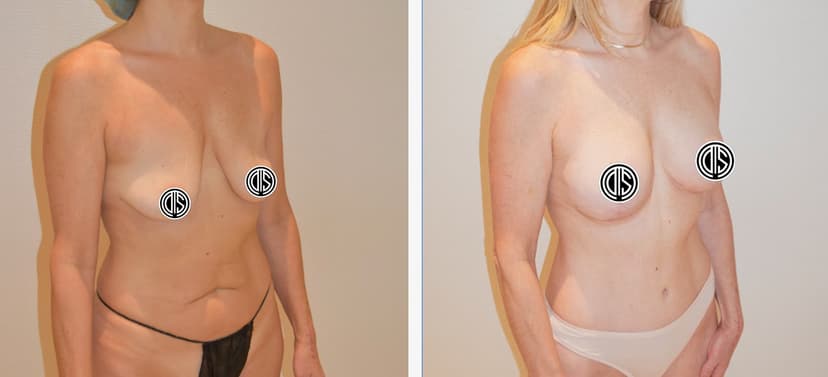 Before and after