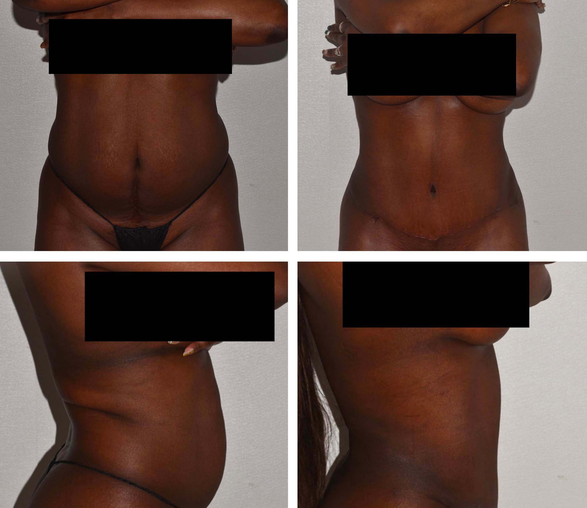 Four side-by-side photos display a woman's midsection and chest from different angles, partially obscured by black boxes, showcasing the before and after results of an abdominoplasty.
