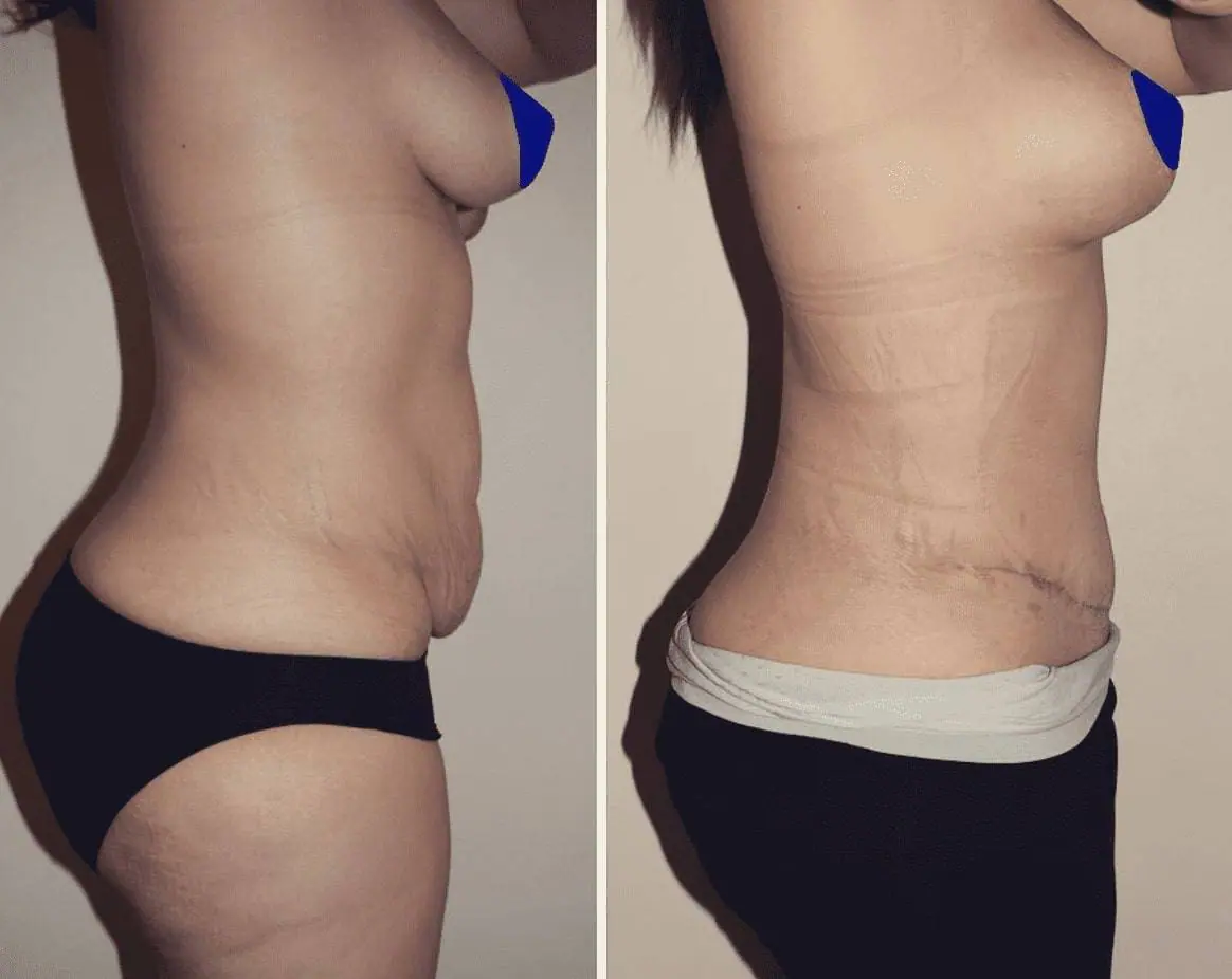 Abdominoplasty before and after photos for tummy tuck transformation.