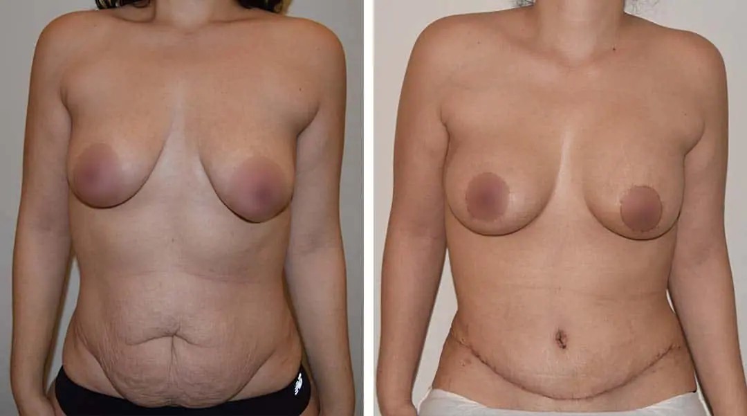 Abdominoplasty before and after photos of breast surgery.