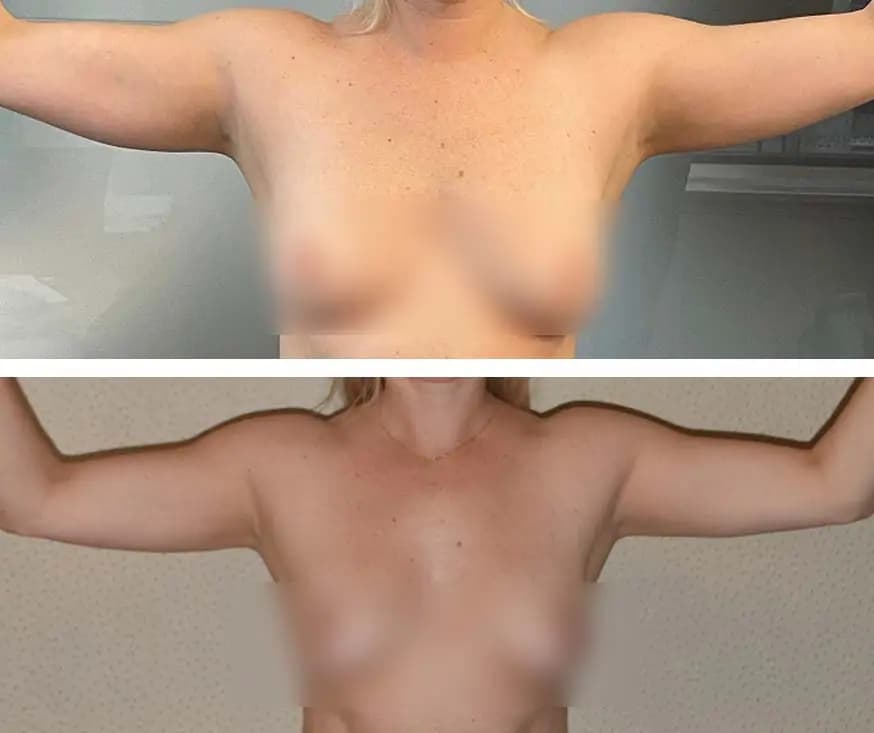 A woman's breasts before and after surgery, featuring results of arm liposuction.