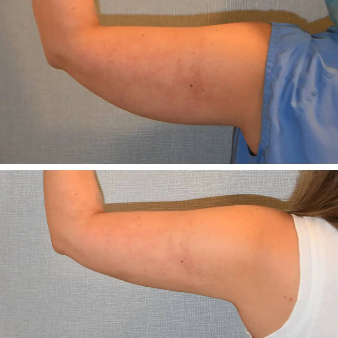 Here is an impressive arm liposuction before and after photo gallery showcasing a woman's transformation.
