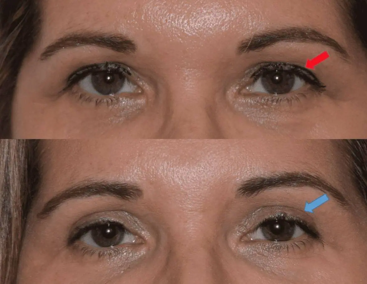 A woman's eyes undergo a transformation with blepharoplasty, as seen in before and after photos.
