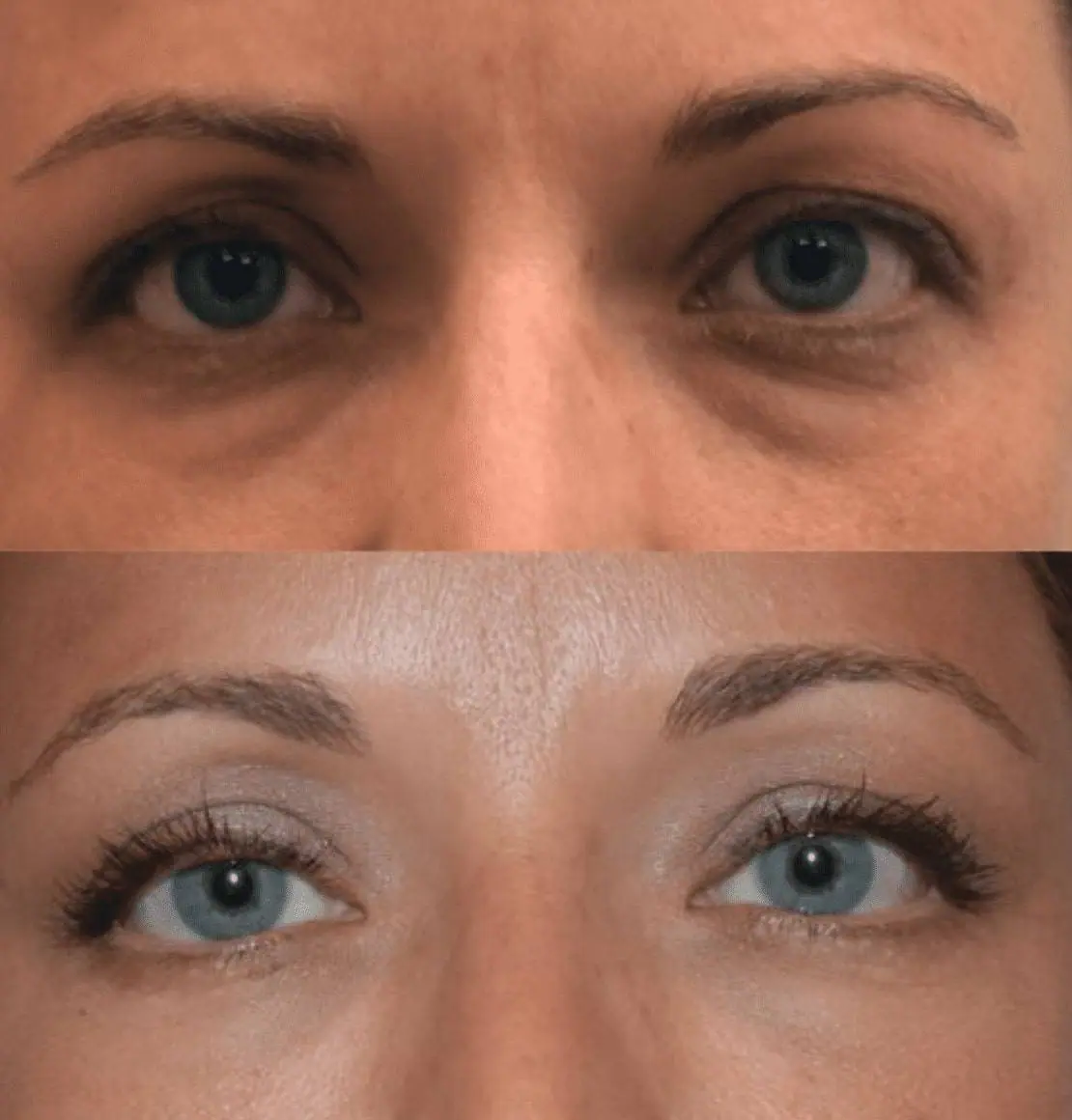 Before and after photos showcasing the effects of Blepharoplasty on a woman's eyelids.