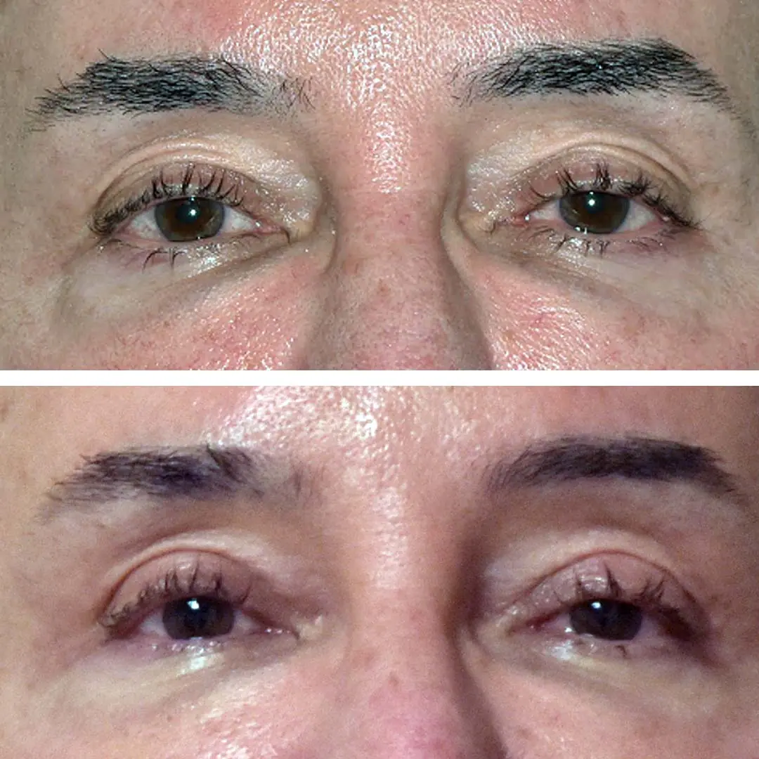 Blepharoplasty before and after photos showcasing a man's eyelids transformation
