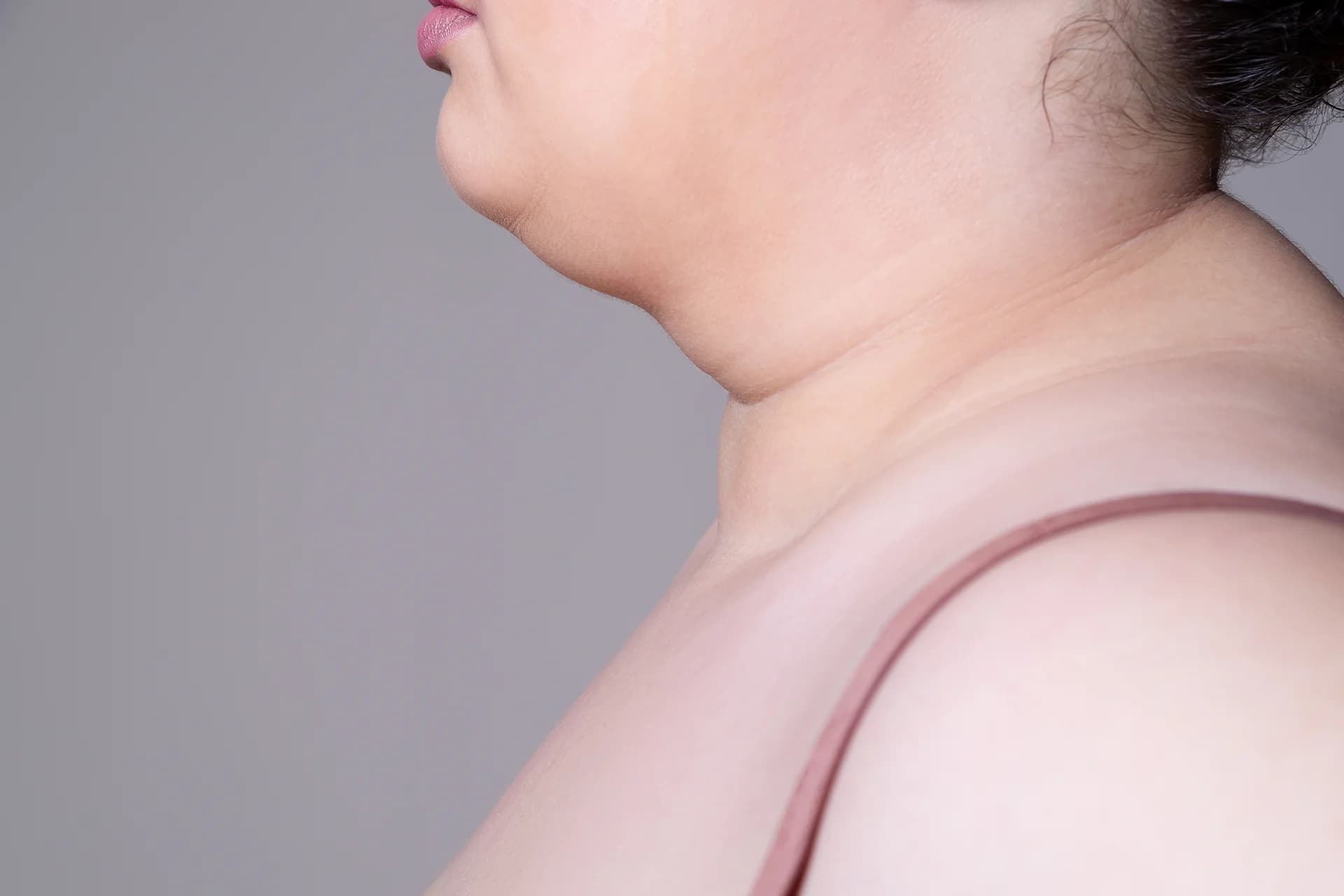 Chin fat pad removal