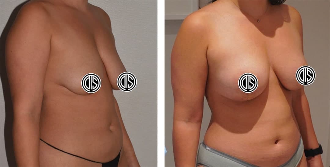 Side-by-side comparison of a woman's torso before and after Fat Transfer Breast Augmentation, with nipples covered by censor marks.