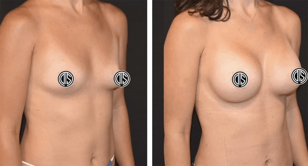 Side-by-side photos showing a woman’s torso before and after Breast Augmentation surgery, with the nipples covered for privacy.