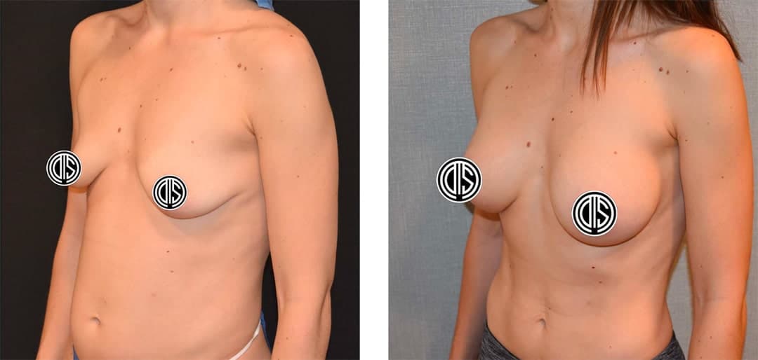 Side-by-side comparison of a woman's torso before and after Breast Augmentation, highlighting the changes in breast size and shape.
