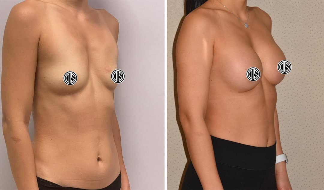 Side-by-side comparison of a woman’s torso before and after breast augmentation, with nipple areas covered by graphic icons.
