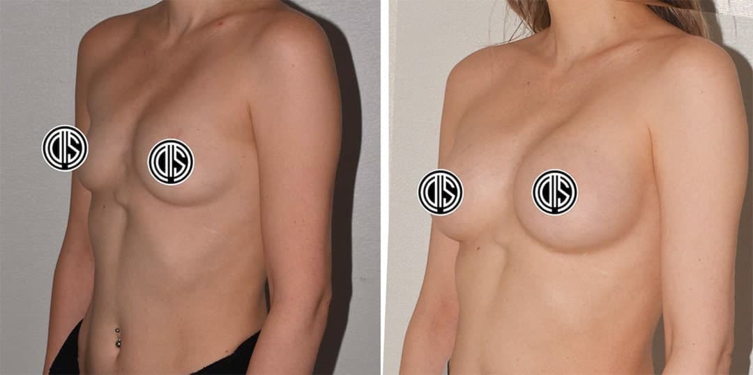 Side-by-side comparison showing a topless person before and after Breast Augmentation surgery, with nipples covered by graphic icons for modesty.