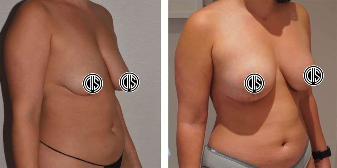 Two side-by-side photos show a woman's torso before and after her Breast Lift surgery; nipples are covered with circular logos for privacy.