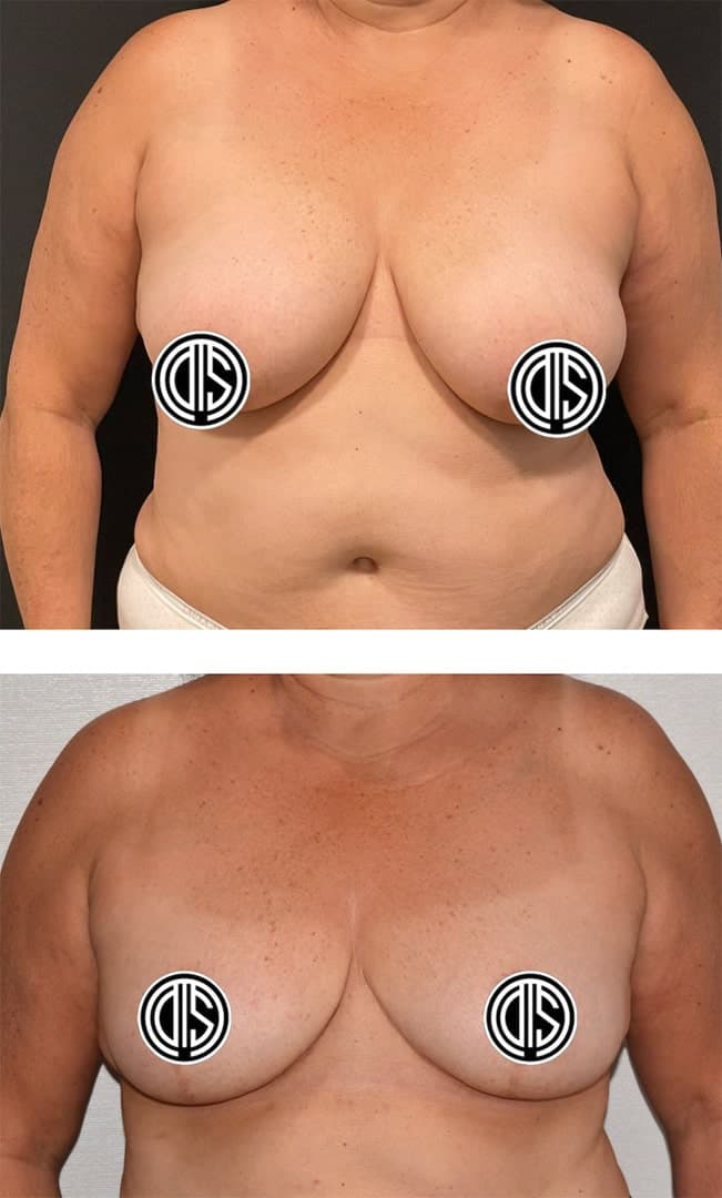Before and after photos of a woman’s torso show Breast Lift results, with nipples covered for privacy.