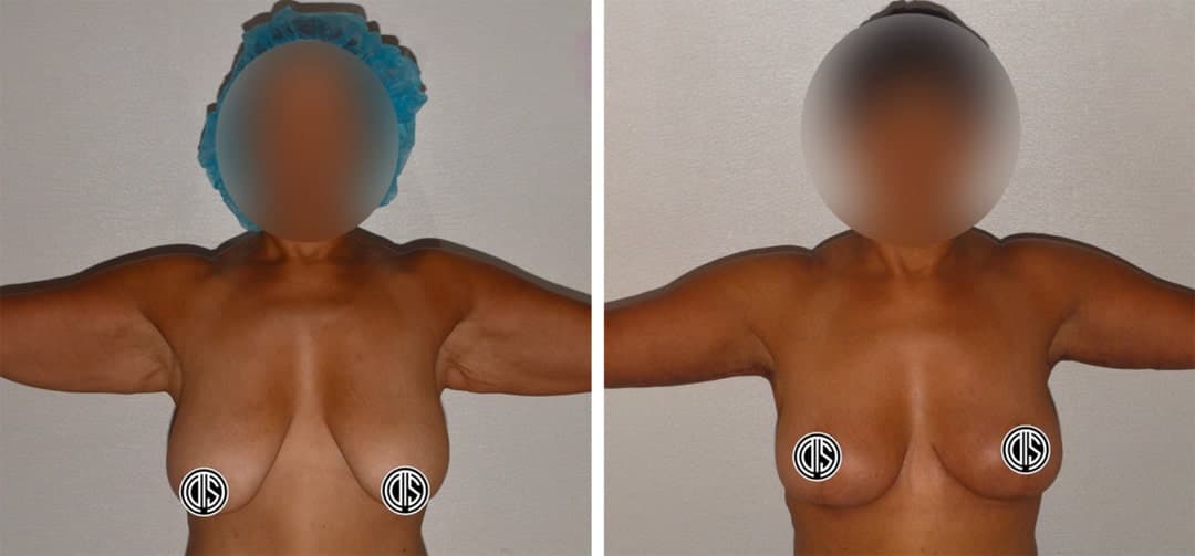 Side-by-side photos showing a person with arms raised before and after a Breast Lift procedure, with face and chest areas obscured for privacy.