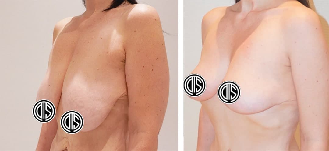 Side-by-side comparison of a woman’s torso before and after a Breast Lift, highlighting noticeable changes in breast shape and position.