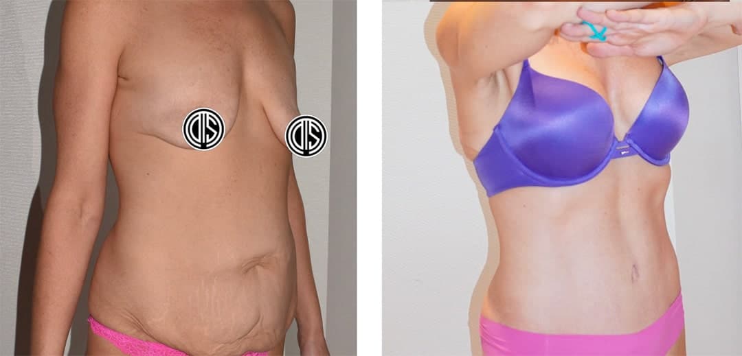Side-by-side comparison of a woman before and after cosmetic surgery, highlighting changes in abdomen and chest following a tummy tuck; before image left, after image right, both partially clothed.