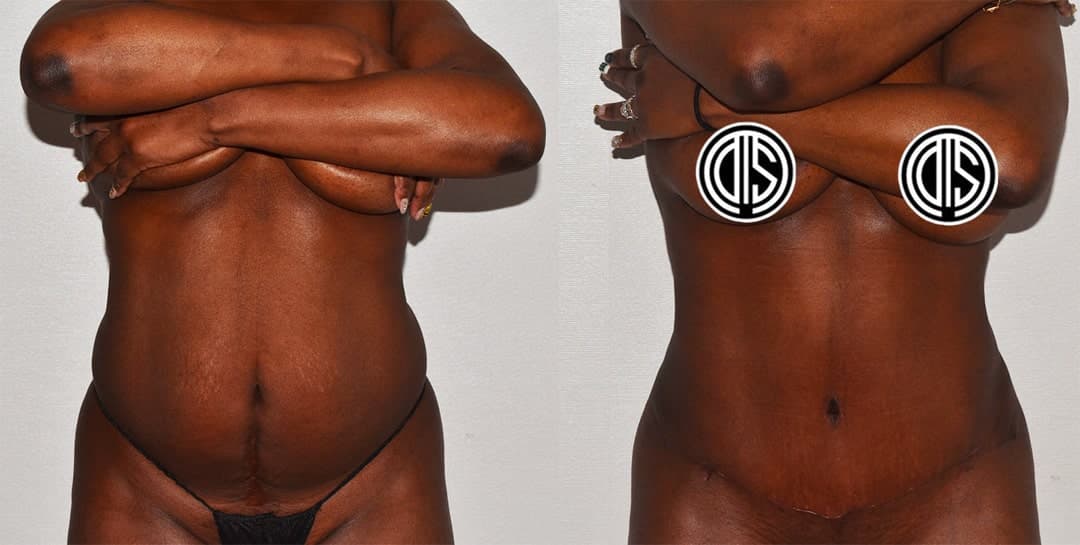 Two side-by-side photos show a woman before and after her tummy tuck surgery, with noticeable changes in body contour and a surgical scar on the lower abdomen visible in the after photo.