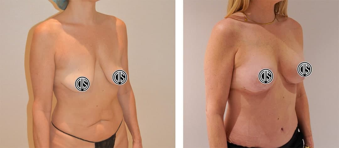 Side-by-side comparison showing a woman's torso before (left) and after (right) breast reconstruction and tummy tuck surgery, with nipples covered for privacy.