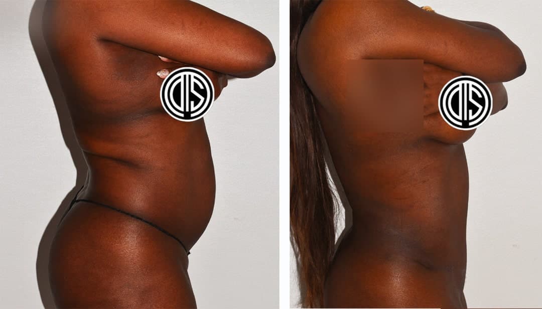 Side-by-side photos of a person before and after a Tummy Tuck procedure, revealing a flatter abdomen and more lifted breasts in the after image.