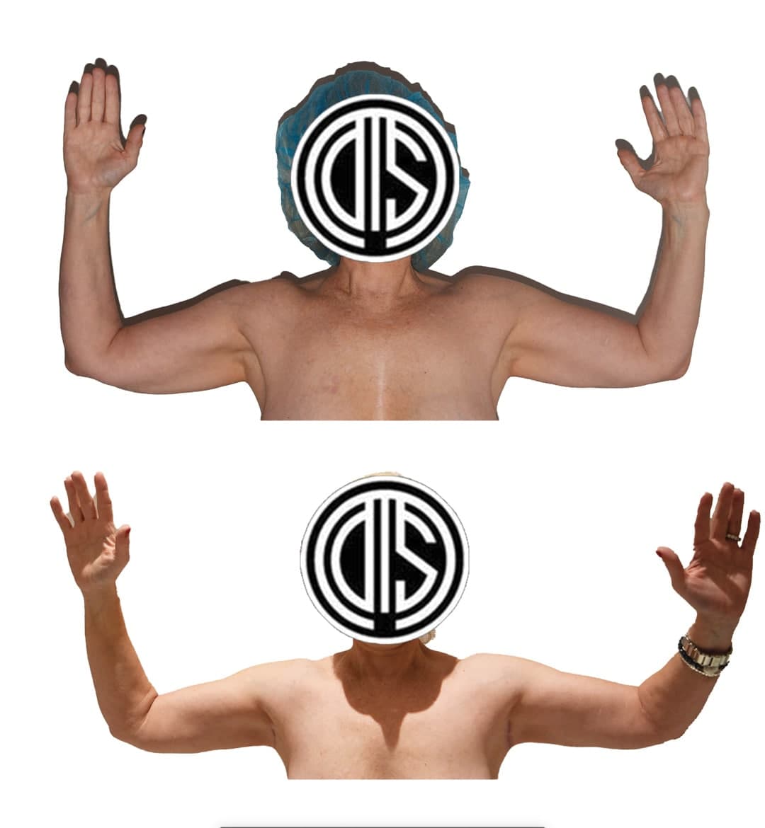 Two shirtless people with arms raised, as if showing off Arm Lift or Brachioplasty results; faces are covered by a circular logo with overlapping letters. One wears a cap, the other sports a watch and ring.