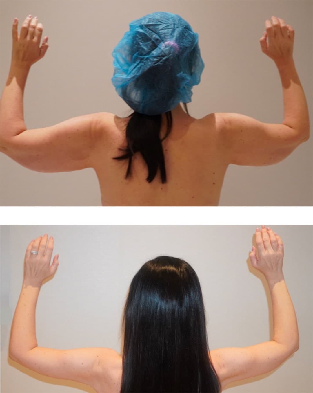 Two images show a woman from behind with arms raised; the top image displays looser skin, while the bottom highlights tighter, more toned arms after an Arm Lift (Brachioplasty).
