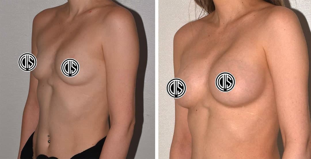 Side-by-side comparison of a person's chest before and after breast augmentation surgery using Motiva Implants, with nipples censored for privacy.