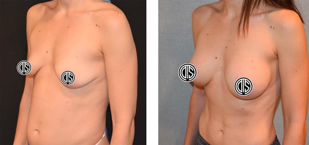 Side-by-side before and after photos of a woman’s torso, showing changes in breast shape and size with Motiva Implants; nipples are covered with circular logos.