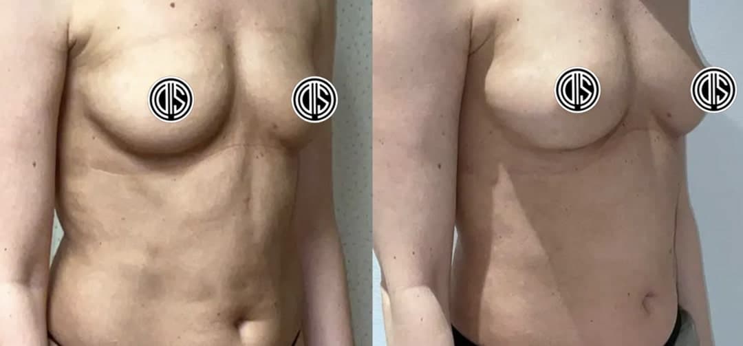 Side-by-side photos show a person's torso before and after Fat Transfer Breast Augmentation, with nipples censored; breast shape and position are visibly different in each image.
