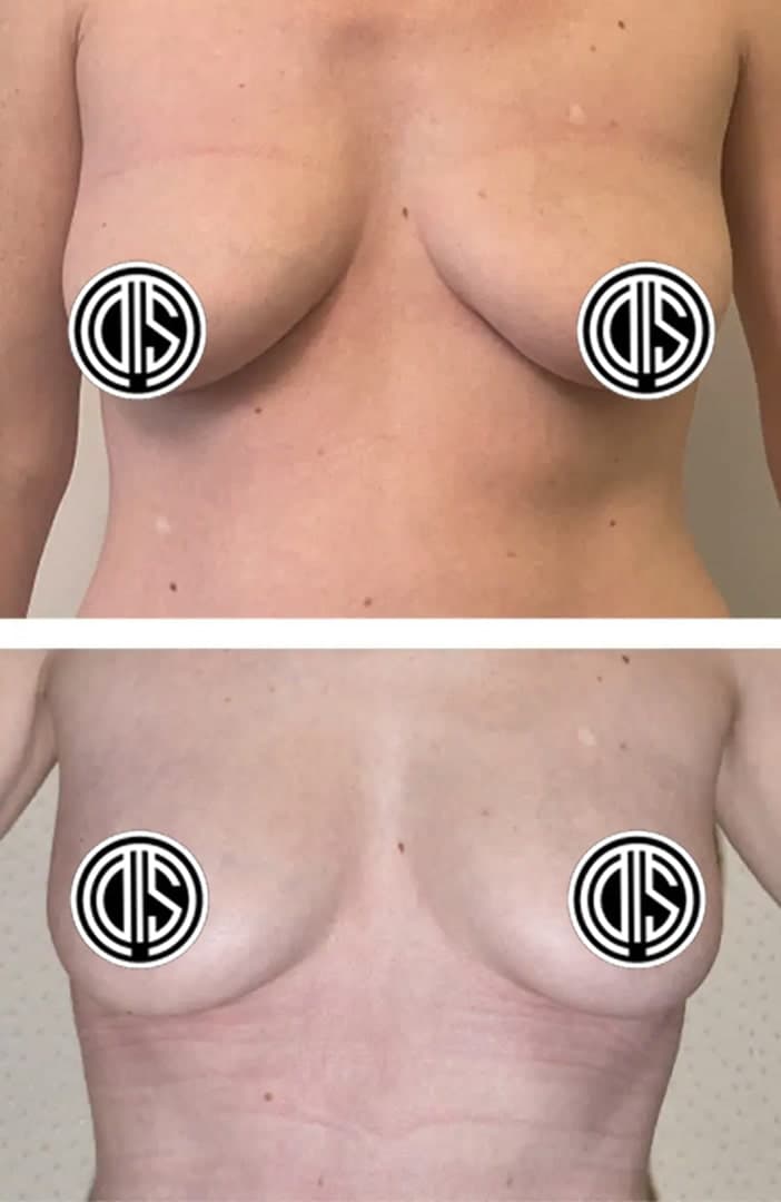 A side-by-side comparison of a woman's chest before and after breast augmentation surgery, with the nipple areas censored by circular logos.
