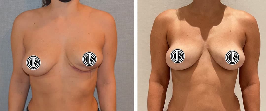 Side-by-side before-and-after photos of a woman’s torso reveal changes in breast shape and position following a Fat Transfer Breast Augmentation procedure, with nipples covered for privacy.