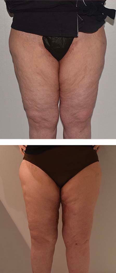 Two side-by-side photos show a person's upper legs and thighs before (top) and after (bottom) a visible body contouring or Thigh Lift (Thighplasty) treatment.