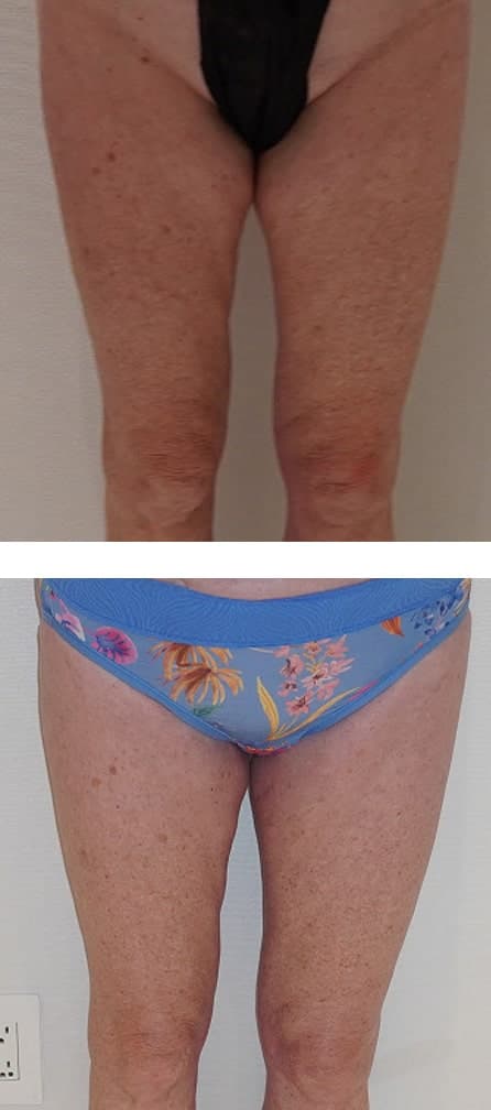 Two photos showing the front view of a person's upper legs before and after a Thigh Lift, with visible differences in skin tone and firmness.