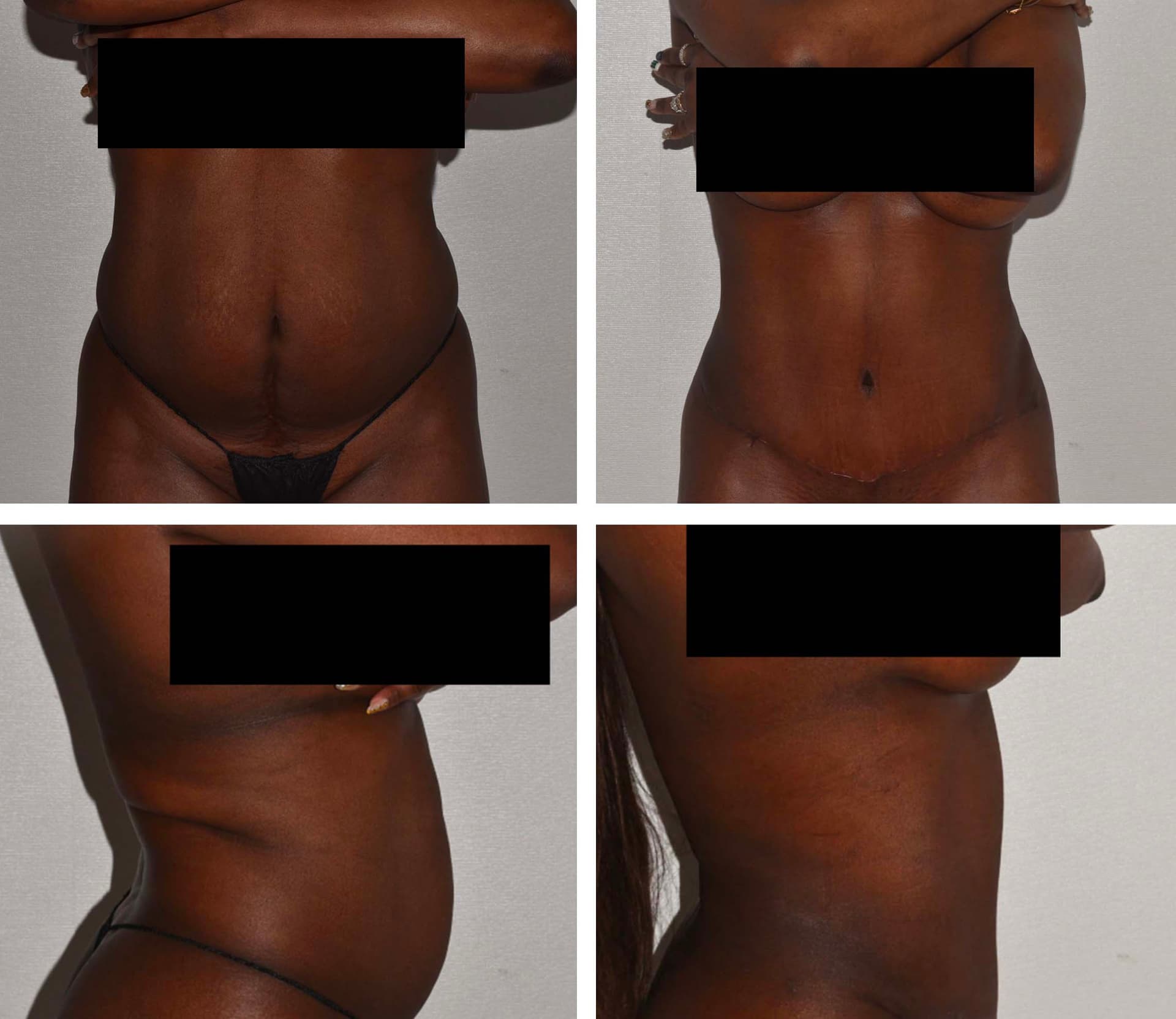 Abdominoplasty Before and After Photos - 5
