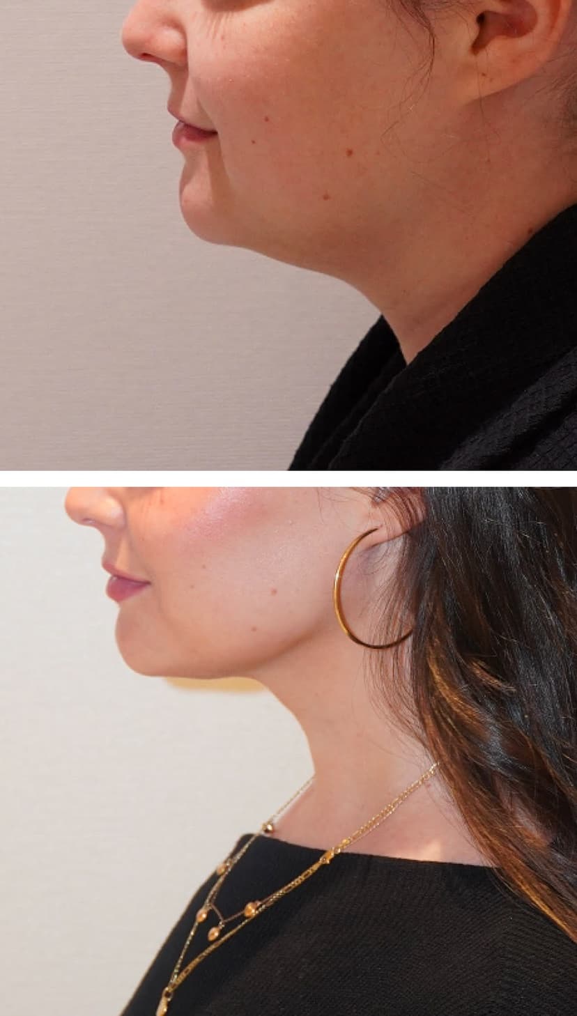 Before and after