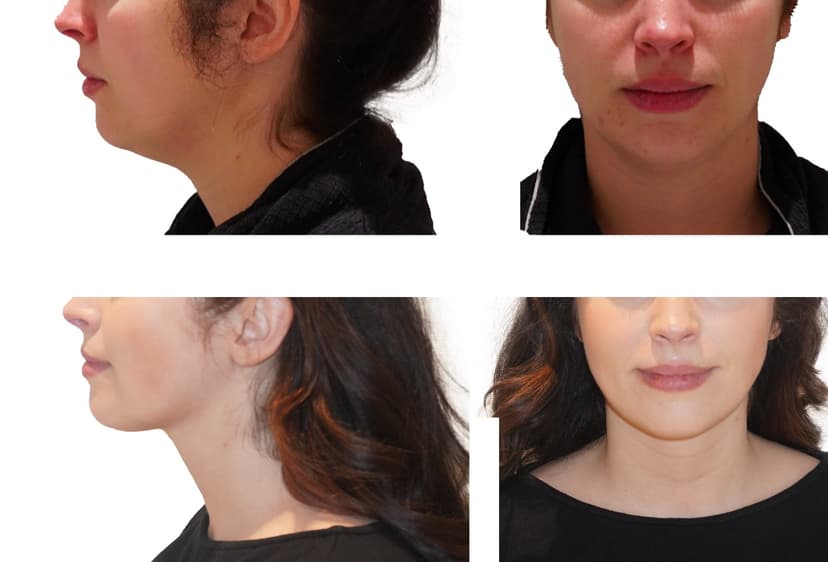 Before and after
