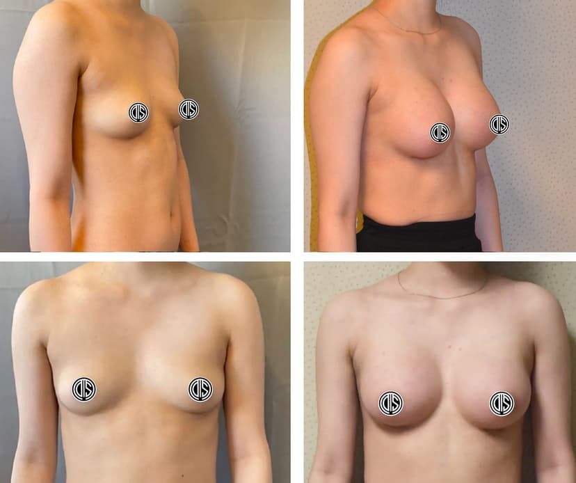 Before and after