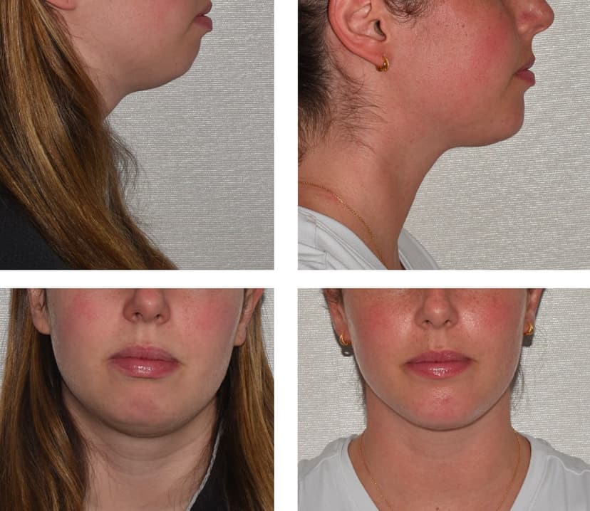 Before and after