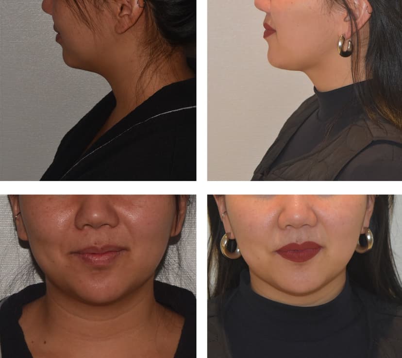 Before and after
