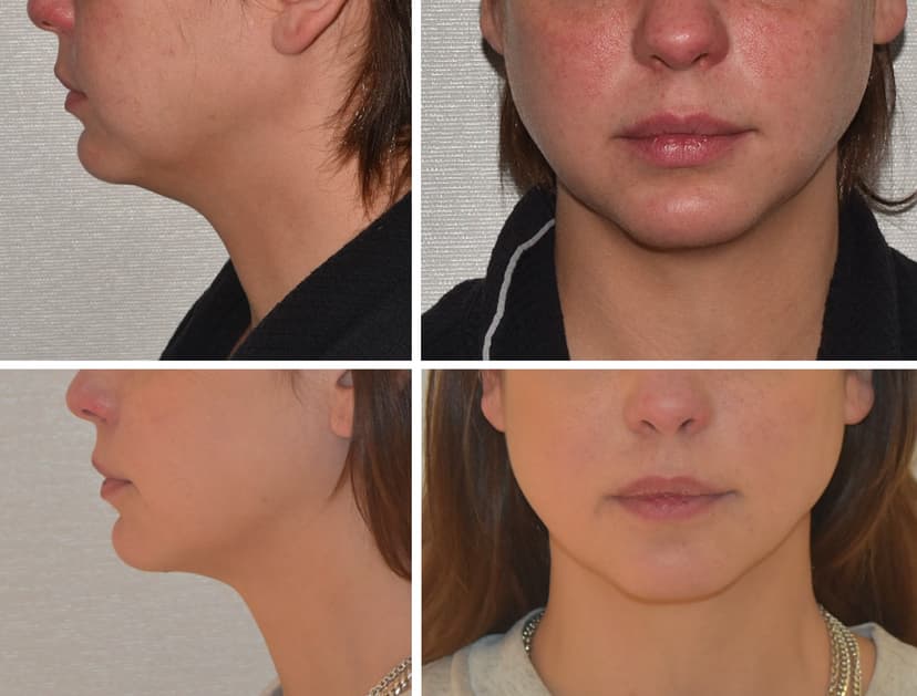 Before and after