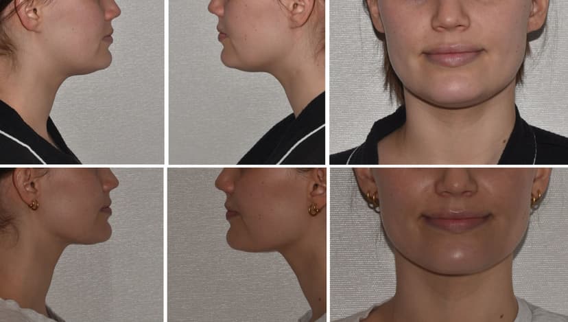 Before and after